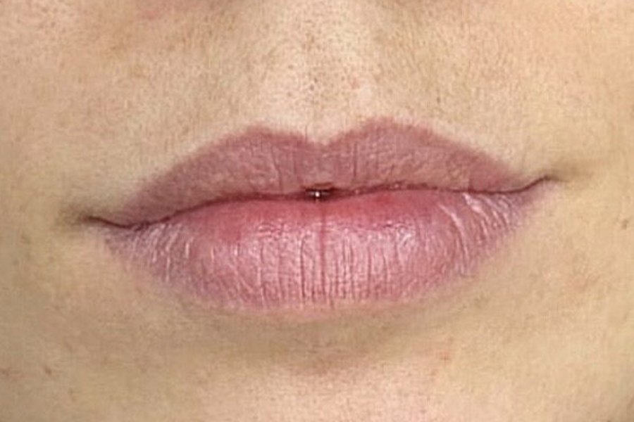 Armonización Facial
