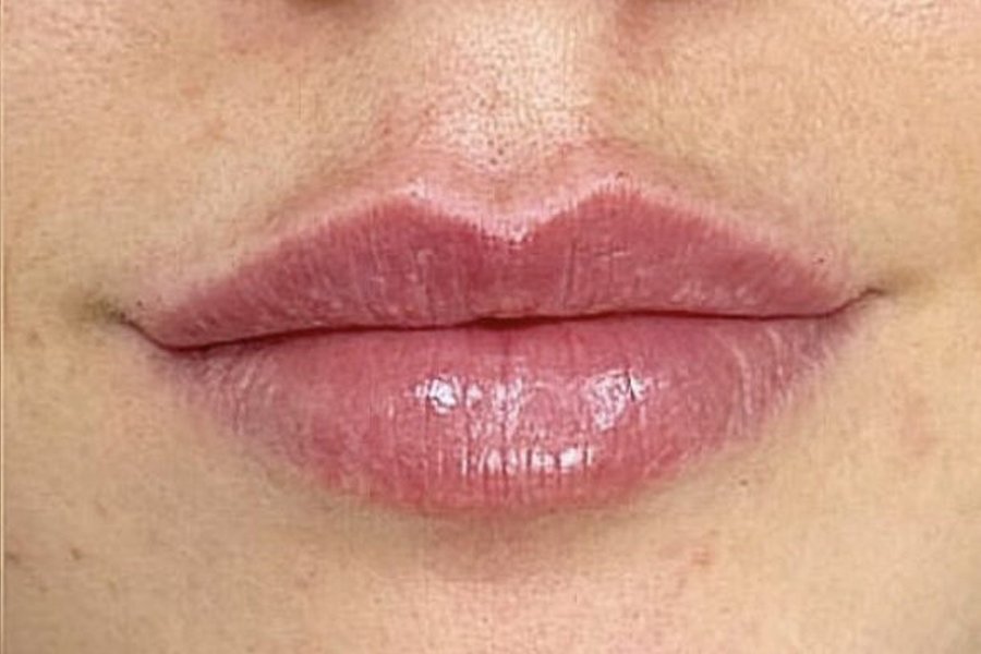 Resultados Armonización Facial