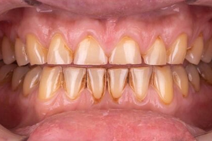 Antes de Diseño de Sonrisa