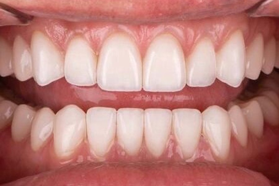Diseño de Sonrisa