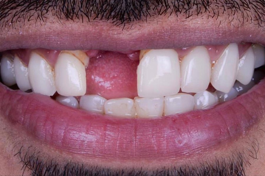 Resultados Implantes Dentales