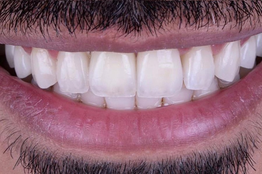 Resultados Implantes Dentales