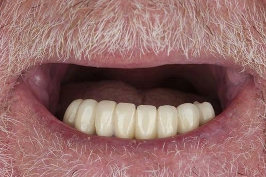 Resultados Implantes Dentales