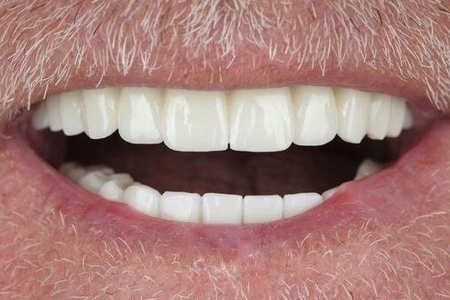 Resultados Implantes Dentales